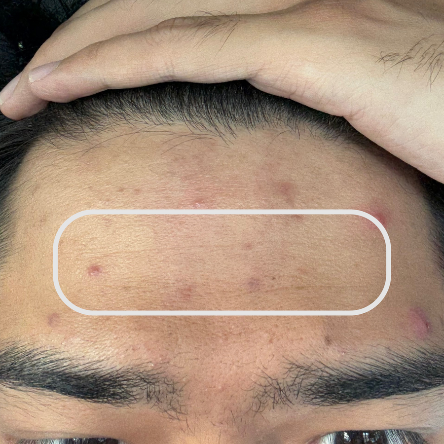 Day 0 — Fine lines