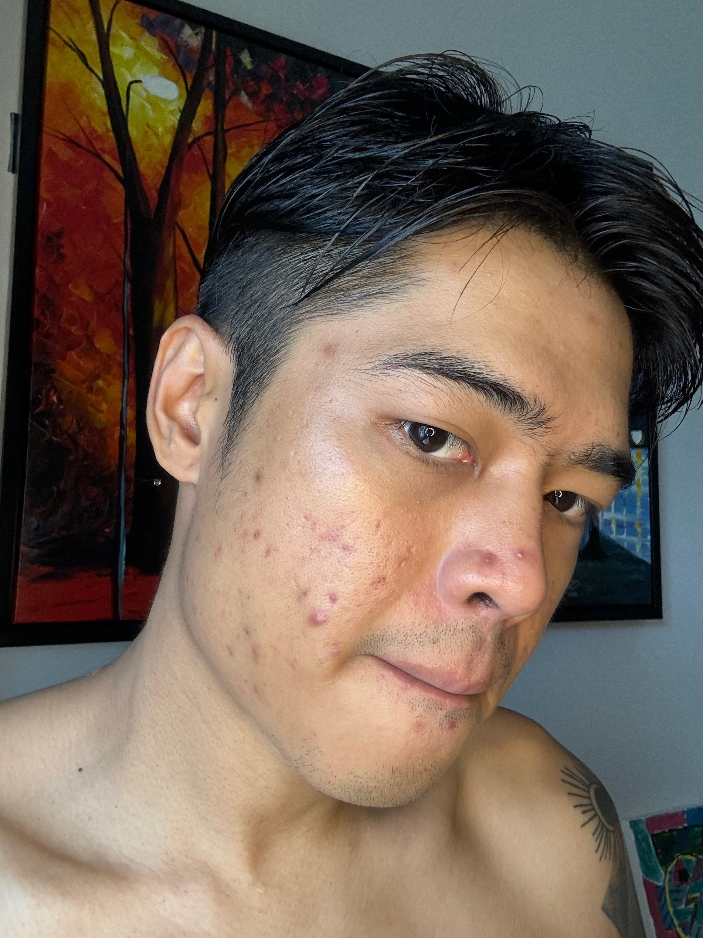 What Can Acne-Prone Skin Use? The Simple Truth
