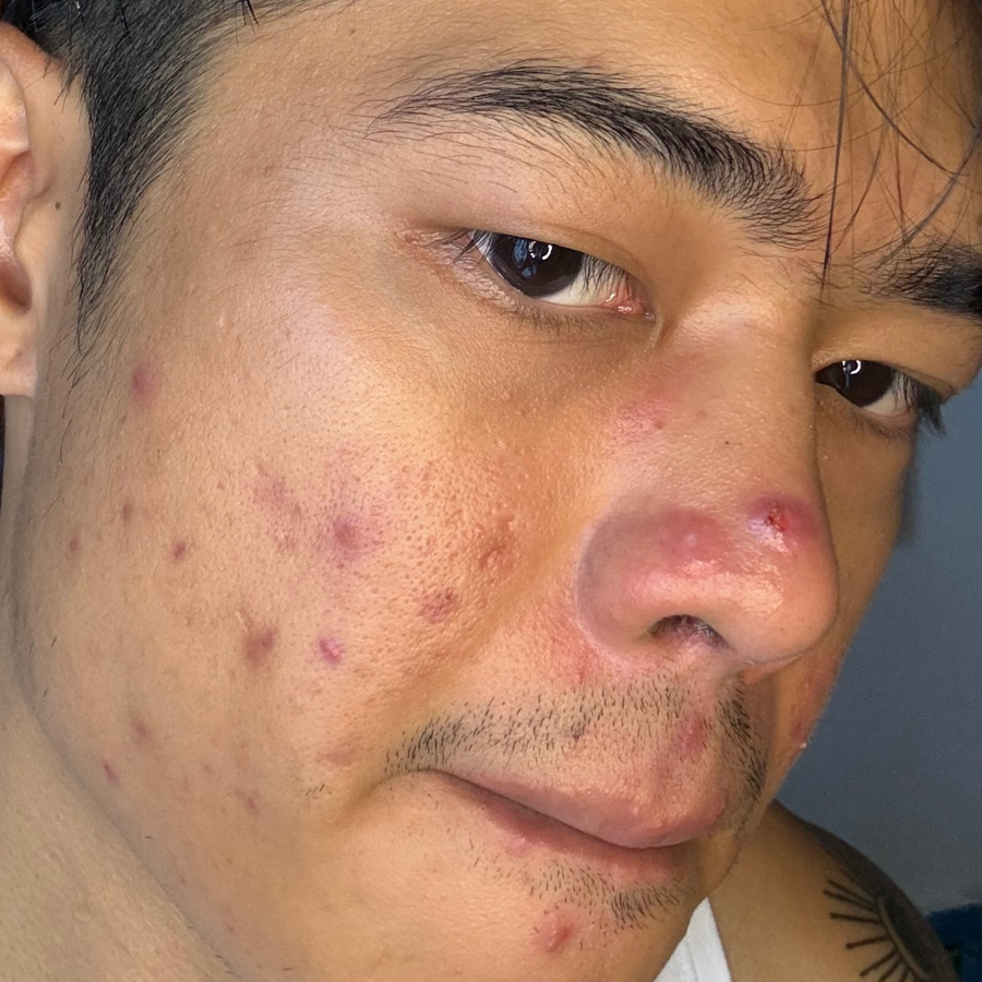 Day 0 — Acne & dullness